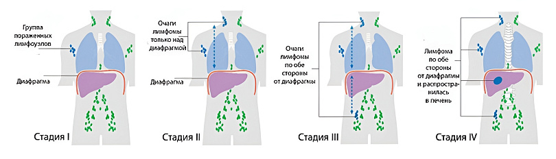 Схематическое изображение четырех стадий лимфомы Ходжкина.