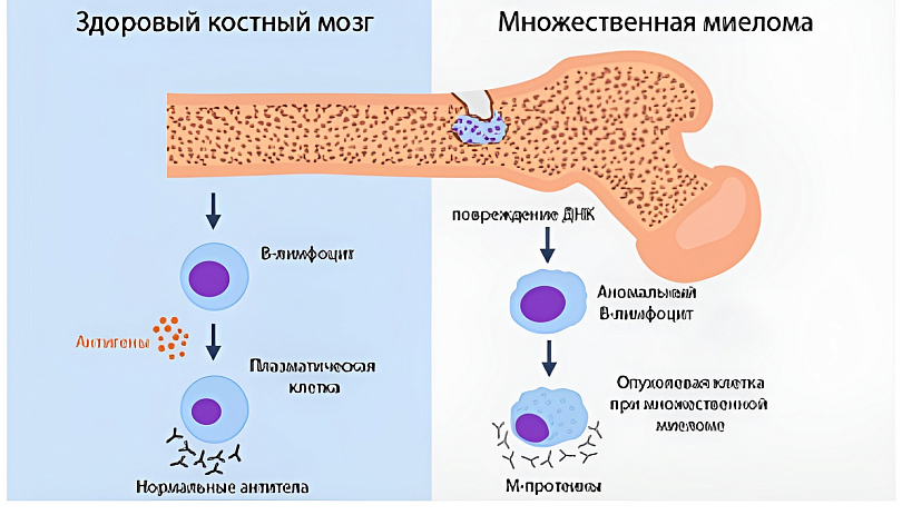 Множественная миелома