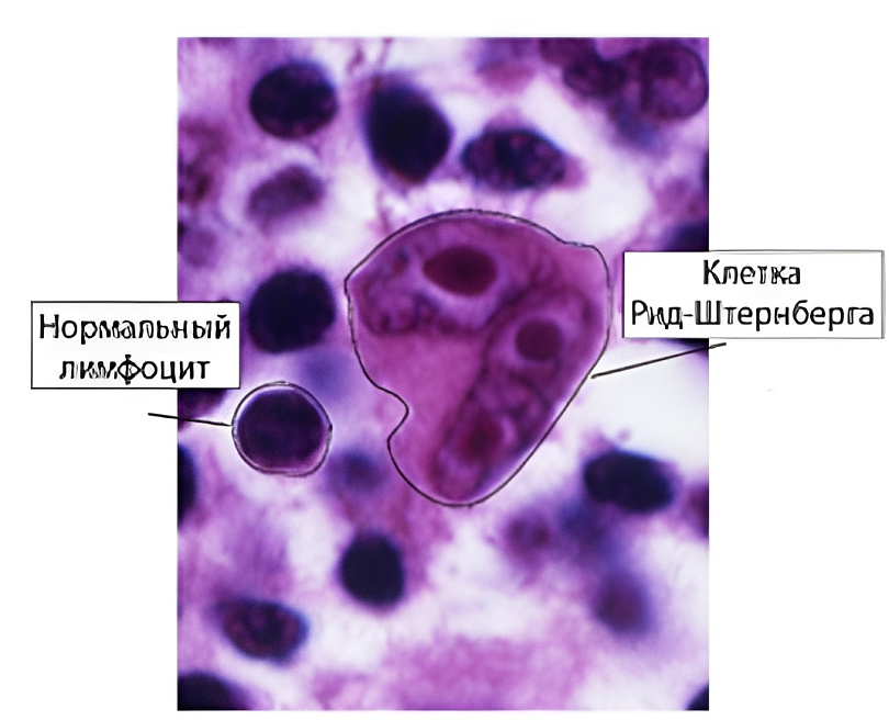Лимфома Ходжкина