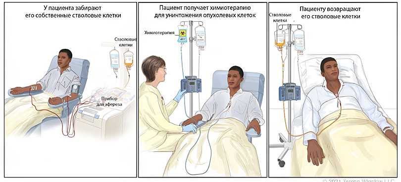 Аутологичная трансплантация костного мозга